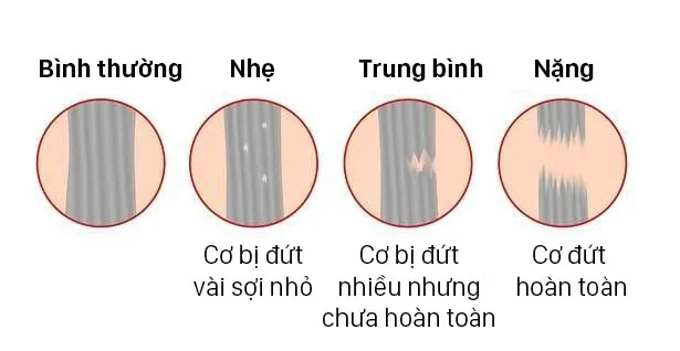 Căng cơ là gì? Dấu hiệu bị căng cơ và cách khắc phục