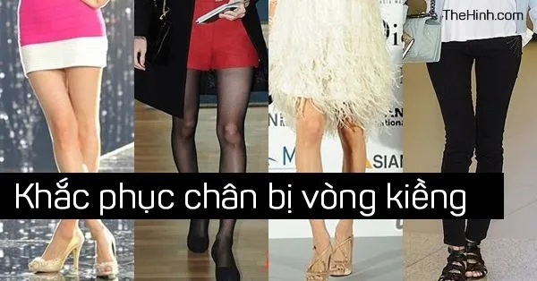 Chân vòng kiềng có chữa được không, chân vòng kiềng mặc gì đẹp ?