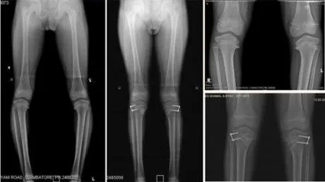 Chân vòng kiềng có chữa được không, chân vòng kiềng mặc gì đẹp ?