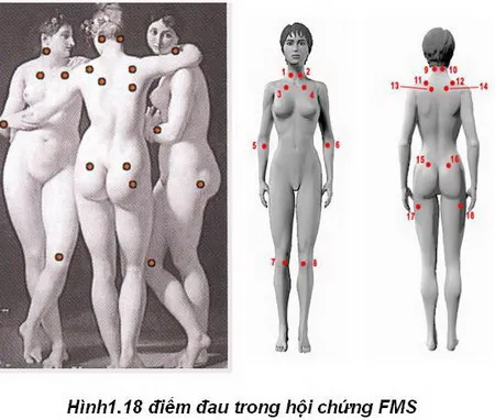 Hội chứng đau cơ xơ hóa là gì? Nguyên nhân và cách điều trị