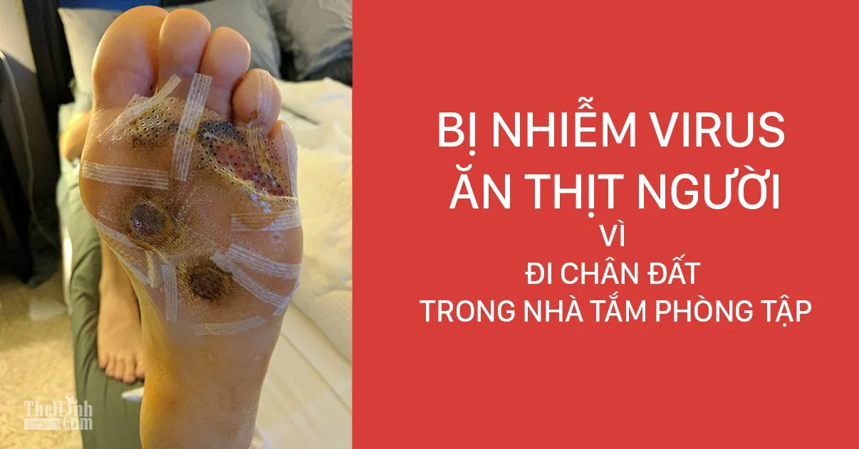 Rợn người bàn chân bị “virut ăn thịt” vì đi chân trần trong nhà tắm phòng tập gym