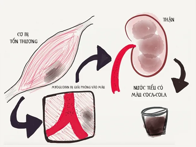 Tiêu cơ vân là gì ? Cần sớm phòng tránh trước khi mắc phải