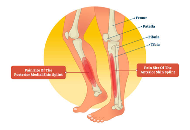 8 chấn thương chân trong chạy bộ thường gặp và cách xử lý