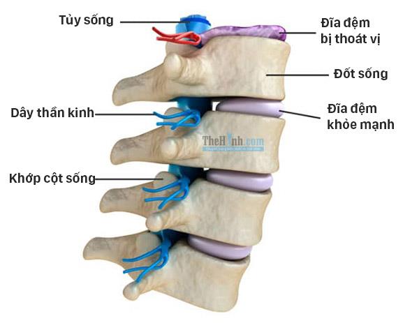 Bị thoát vị đĩa đệm có nên tập gym không, làm sao để nhanh phục hồi ?