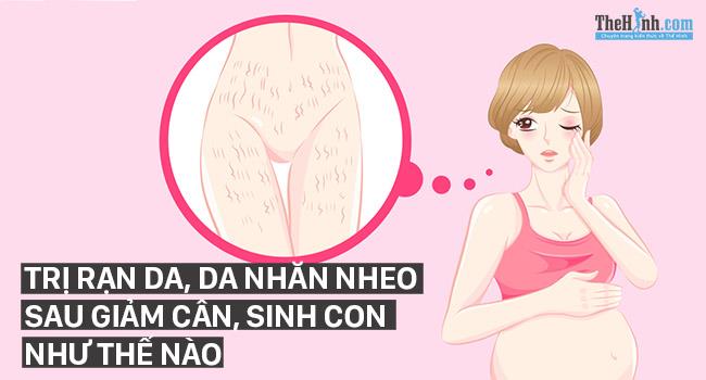 Cách trị rạn da sau sinh, da chảy xệ sau giảm cân tại nhà hiệu quả