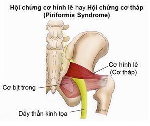 Trị đau thần kinh tọa tại nhà nhanh chóng bằng 7 bài tập Yoga