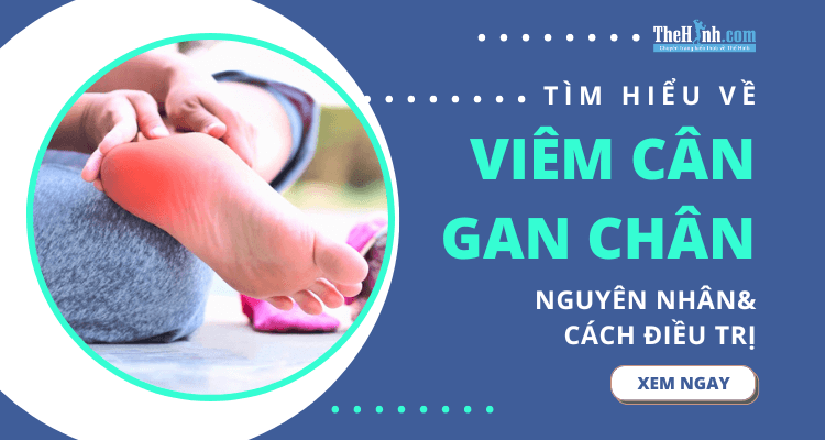 Viêm cân gan chân là gì? Nguyên nhân và cách điều trị