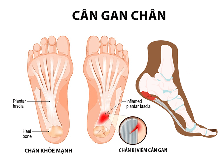 Viêm cân gan chân là gì? Nguyên nhân và cách điều trị