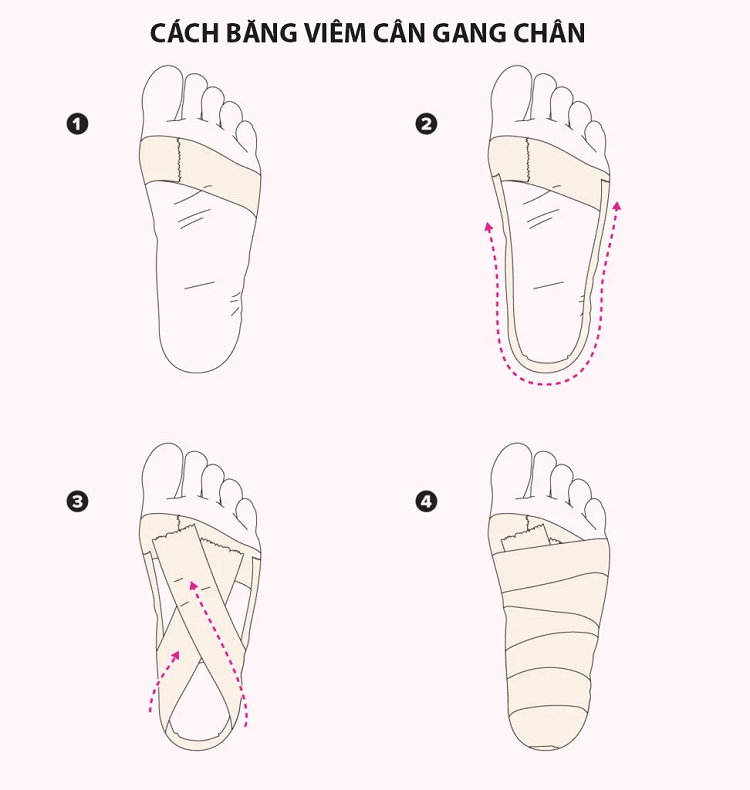 Viêm cân gan chân là gì? Nguyên nhân và cách điều trị