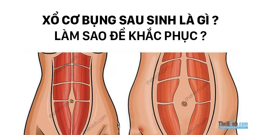 Xổ bụng sau sinh là gì ? Khắc phục tách cơ bụng sau sinh như thế nào ?