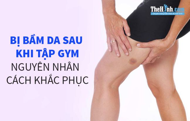 Bị vết bầm trên da sau khi tập gym, nguyên nhân và cách xử lý